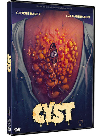 Cyst